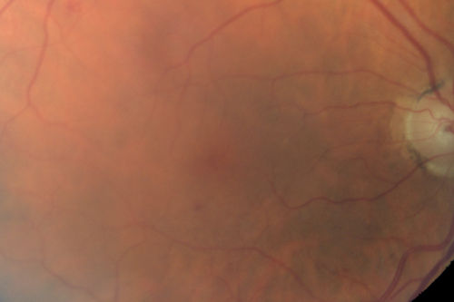 Branch Retinal Vein Occlusion with worse macular edema from hypertension - Photo from 2014 - vision 20/40
