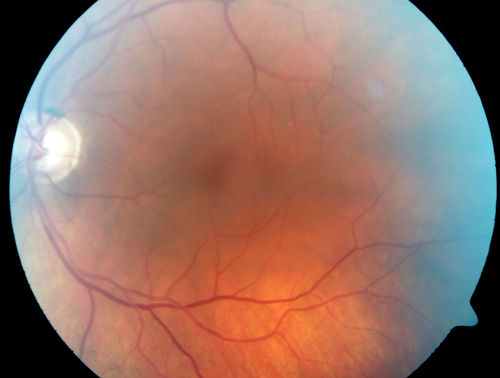 Branch Retinal Vein Occlusion with worse macular edema from hypertension - Photo from 2014 - vision 20/40

