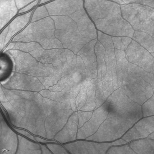 Branch Retinal Vein Occlusion with worse macular edema from hypertension - FAF Photo from 2014 - vision 20/40
