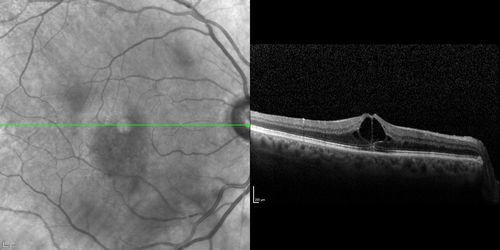Branch Retinal Vein Occlusion with worse macular edema from hypertension - SD-OCT shows Edema Right Eye
