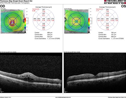 Branch Retinal Vein Occlusion with worse macular edema from hypertension - SD-OCT shows Edema Right Eye
