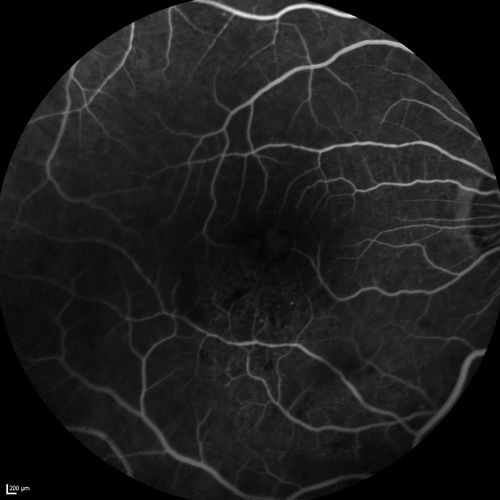 Branch Retinal Vein Occlusion with worse macular edema from hypertension - FA shows Edema Right Eye
