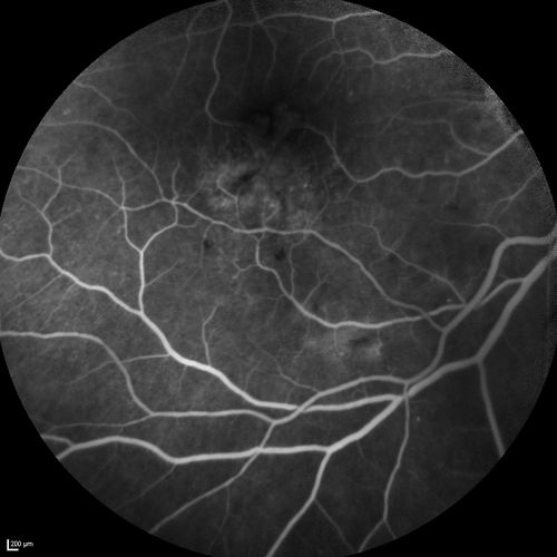 Branch Retinal Vein Occlusion with worse macular edema from hypertension - FA shows Edema Right Eye
Keywords: Branch Retinal Vein Occlusion with worse macular edema from hypertension - FA shows Edema Right Eye