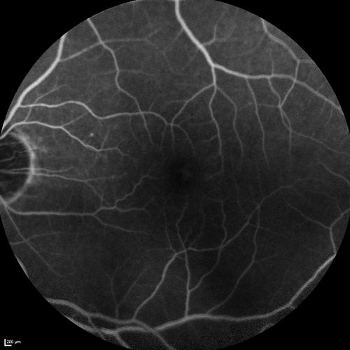 Branch Retinal Vein Occlusion with worse macular edema from hypertension - FA shows Edema Right Eye
