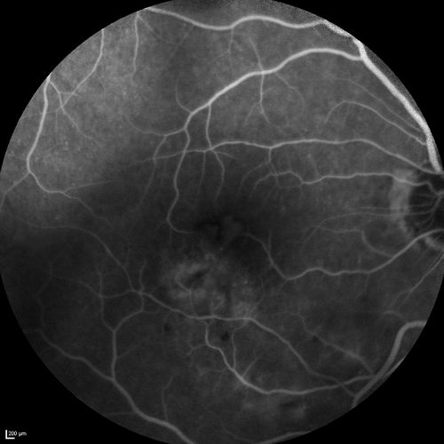 Branch Retinal Vein Occlusion with worse macular edema from hypertension - FA shows Edema Right Eye
