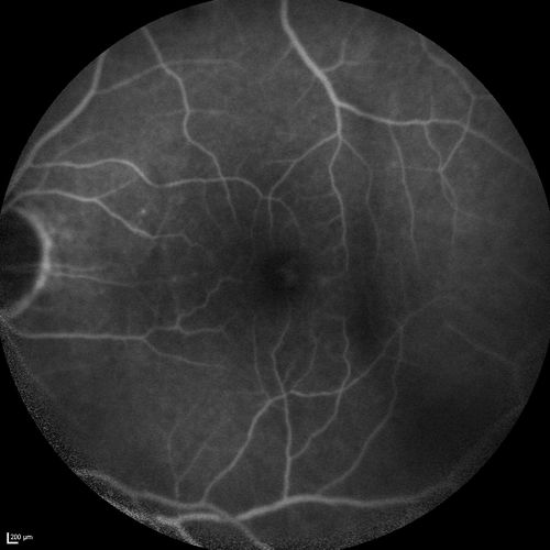 Branch Retinal Vein Occlusion with worse macular edema from hypertension - FA shows Edema Right Eye
