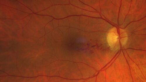 Twig (Macular) Branch Retinal Vein Occlusion with no symptoms
73 year old female with 20/25 vision and no symptoms
