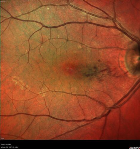 Twig (Macular) Branch Retinal Vein Occlusion with no symptoms
73 year old female with 20/25 vision and no symptoms
