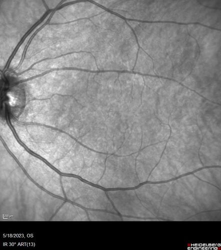 Twig (Macular) Branch Retinal Vein Occlusion with no symptoms
73 year old female with 20/25 vision and no symptoms
