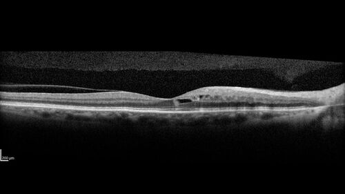 Twig (Macular) Branch Retinal Vein Occlusion with no symptoms
73 year old female with 20/25 vision and no symptoms
