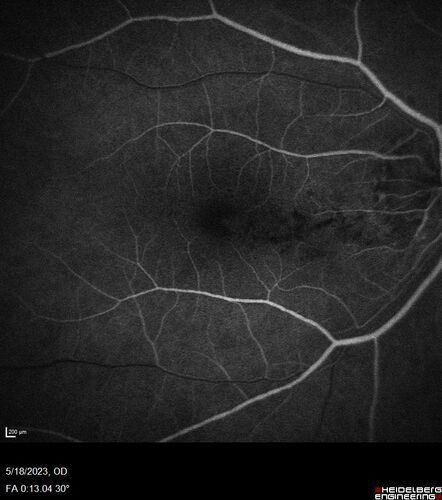 Twig (Macular) Branch Retinal Vein Occlusion with no symptoms
73 year old female with 20/25 vision and no symptoms
