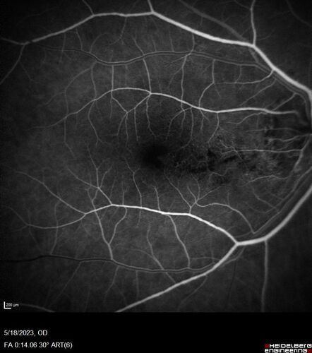 Twig (Macular) Branch Retinal Vein Occlusion with no symptoms
73 year old female with 20/25 vision and no symptoms
