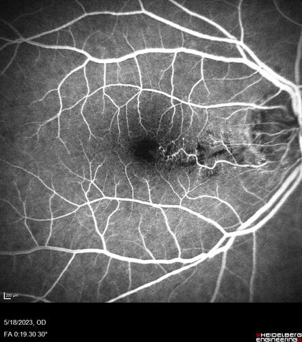 Twig (Macular) Branch Retinal Vein Occlusion with no symptoms
73 year old female with 20/25 vision and no symptoms
