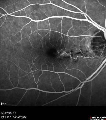 Twig (Macular) Branch Retinal Vein Occlusion with no symptoms
73 year old female with 20/25 vision and no symptoms
