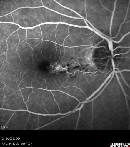 Twig (Macular) Branch Retinal Vein Occlusion with no symptoms
73 year old female with 20/25 vision and no symptoms
