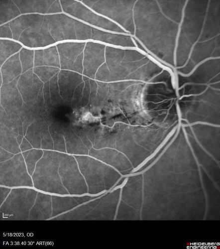 Twig (Macular) Branch Retinal Vein Occlusion with no symptoms
73 year old female with 20/25 vision and no symptoms
