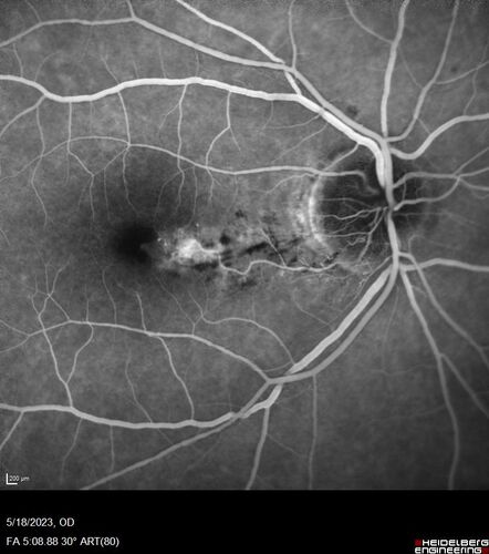 Twig (Macular) Branch Retinal Vein Occlusion with no symptoms
73 year old female with 20/25 vision and no symptoms
