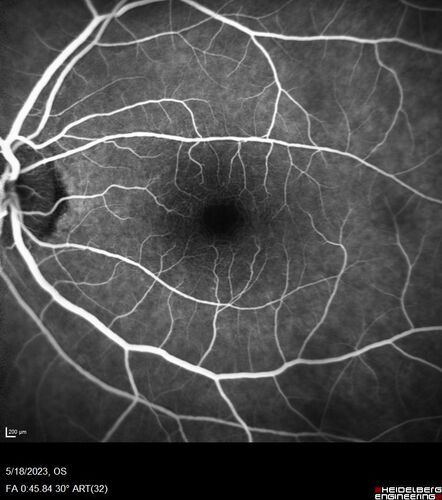 Twig (Macular) Branch Retinal Vein Occlusion with no symptoms
73 year old female with 20/25 vision and no symptoms
