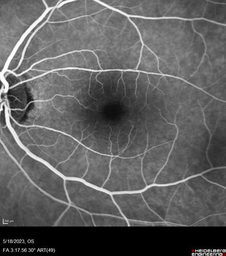 Twig (Macular) Branch Retinal Vein Occlusion with no symptoms
73 year old female with 20/25 vision and no symptoms
