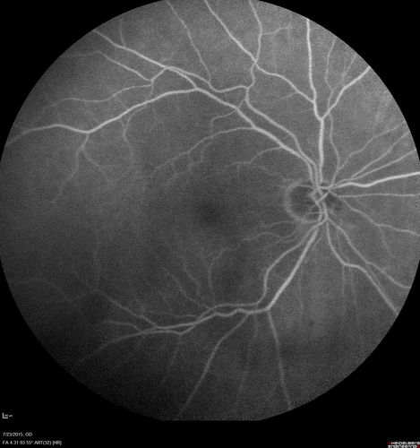 Branch Retinal Vein Occlusion
84 year old man - 2 months vision loss - VA 20/40 - 20/20 with one injection of Eylea
