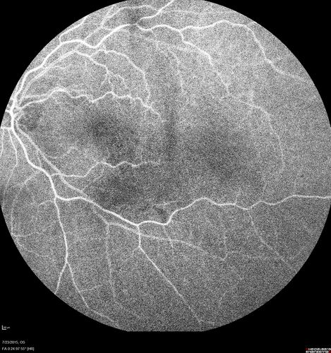 Branch Retinal Vein Occlusion
84 year old man - 2 months vision loss - VA 20/40 - 20/20 with one injection of Eylea
