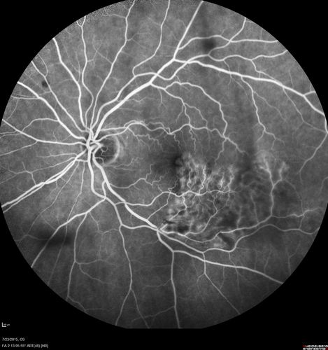 Branch Retinal Vein Occlusion
84 year old man - 2 months vision loss - VA 20/40 - 20/20 with one injection of Eylea
