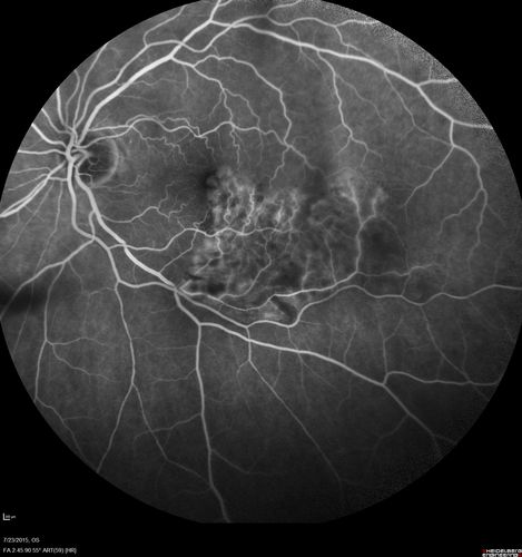 Branch Retinal Vein Occlusion
84 year old man - 2 months vision loss - VA 20/40 - 20/20 with one injection of Eylea
