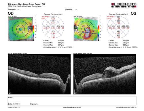 Branch Retinal Vein Occlusion
84 year old man - 2 months vision loss - VA 20/40 - 20/20 with one injection of Eylea
