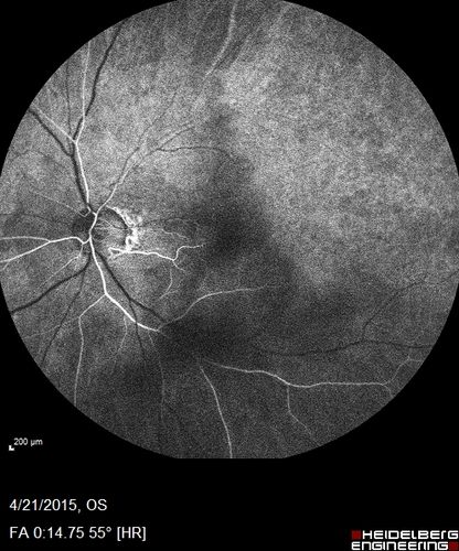 Ischemic BRVO with non-perfusion (nonperfusion) - recovered from severe vitreous hemorrhage

