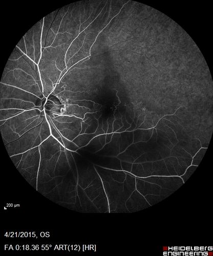 Ischemic BRVO with non-perfusion (nonperfusion) - recovered from severe vitreous hemorrhage
