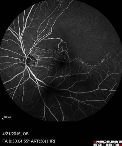 Ischemic BRVO with non-perfusion (nonperfusion) - recovered from severe vitreous hemorrhage
