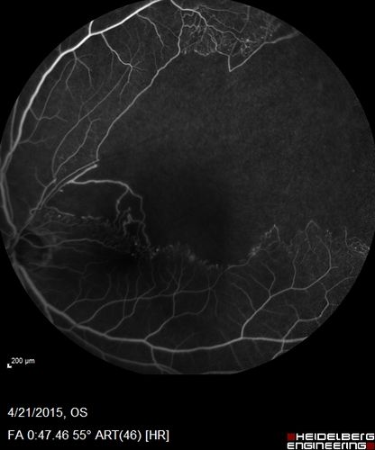 Ischemic BRVO with non-perfusion (nonperfusion) - recovered from severe vitreous hemorrhage
