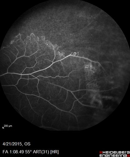 Ischemic BRVO with non-perfusion (nonperfusion) - recovered from severe vitreous hemorrhage
