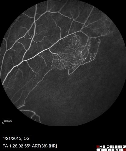 Ischemic BRVO with non-perfusion (nonperfusion) - recovered from severe vitreous hemorrhage
Vascular remodeling
