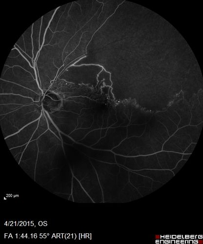 Ischemic BRVO with non-perfusion (nonperfusion) - recovered from severe vitreous hemorrhage
