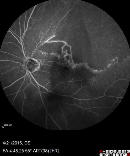Ischemic BRVO with non-perfusion (nonperfusion) - recovered from severe vitreous hemorrhage
