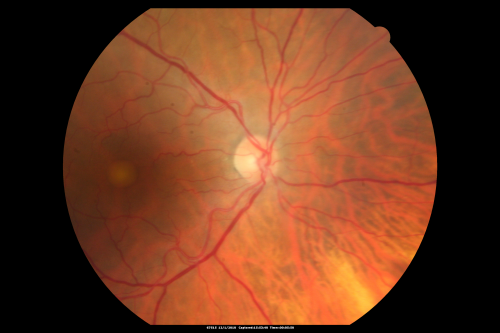 Pattern Dystrophy - Adult Vitelliform Macular Degeneration
72-year-old woman 2 months post ECCE with poor vision since surgery especially left eye.
VISUAL ACUITY:  OD 20/50,  OS 20/200
