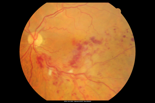 Macular Branch Retinal Vein Occlusion and Adult Vitelliform Dystrophy
72-year-old woman 2 months post ECCE with poor vision since surgery especially left eye.
VISUAL ACUITY:  OD 20/50,  OS 20/200
