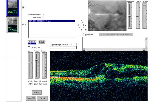Macular Branch Retinal Vein Occlusion and Adult Vitelliform Dystrophy
72-year-old woman 2 months post ECCE with poor vision since surgery especially left eye.
VISUAL ACUITY:  OD 20/50,  OS 20/200
