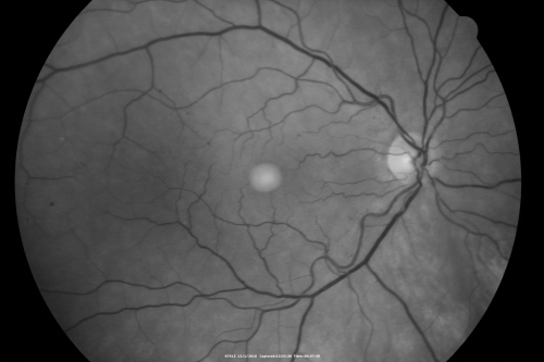 Pattern Dystrophy - Adult Vitelliform Macular Degeneration
72-year-old woman 2 months post ECCE with poor vision since surgery especially left eye.
VISUAL ACUITY:  OD 20/50,  OS 20/200
