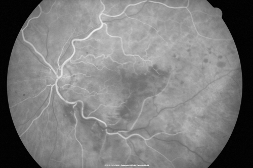 Macular Branch Retinal Vein Occlusion and Adult Vitelliform Dystrophy
72-year-old woman 2 months post ECCE with poor vision since surgery especially left eye.
VISUAL ACUITY:  OD 20/50,  OS 20/200
