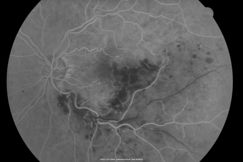 Macular Branch Retinal Vein Occlusion and Adult Vitelliform Dystrophy
72-year-old woman 2 months post ECCE with poor vision since surgery especially left eye.
VISUAL ACUITY:  OD 20/50,  OS 20/200
