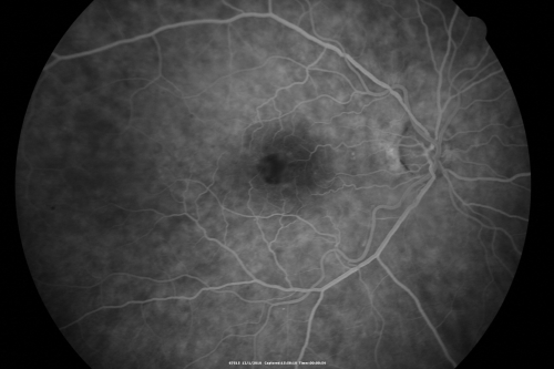 Pattern Dystrophy - Adult Vitelliform Macular Degeneration
72-year-old woman 2 months post ECCE with poor vision since surgery especially left eye.
VISUAL ACUITY:  OD 20/50,  OS 20/200
