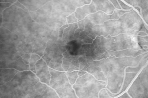 Pattern Dystrophy - Adult Vitelliform Macular Degeneration
72-year-old woman 2 months post ECCE with poor vision since surgery especially left eye.
VISUAL ACUITY:  OD 20/50,  OS 20/200
