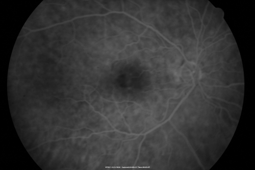 Pattern Dystrophy - Adult Vitelliform Macular Degeneration
72-year-old woman 2 months post ECCE with poor vision since surgery especially left eye.
VISUAL ACUITY:  OD 20/50,  OS 20/200

