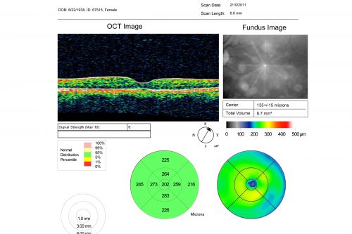 Pattern Dystrophy - Adult Vitelliform Macular Degeneration
72-year-old woman 2 months post ECCE with poor vision since surgery especially left eye.
VISUAL ACUITY:  OD 20/50,  OS 20/200
