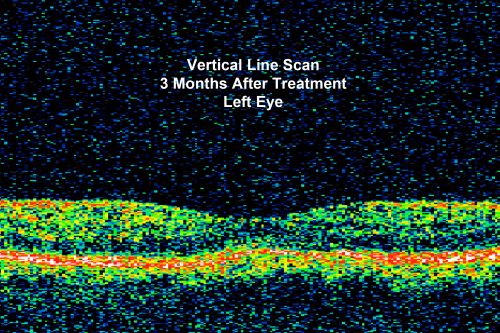Pattern Dystrophy - Adult Vitelliform Macular Degeneration
72-year-old woman 2 months post ECCE with poor vision since surgery especially left eye.
VISUAL ACUITY:  OD 20/50,  OS 20/200

