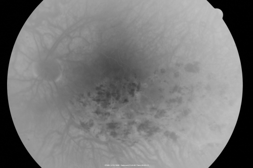 Branch Retinal Vein Occlusion with Macular Edema
Central foveal thickness came to normal after laser and intravitreal Kenalog
