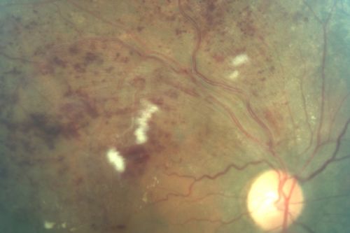 Branch Retinal Vein Occlusion with Cotton Wool Spot 
70-year-old man with blurred vision in the right eye for about one or two months. OD is 20/80, OS is 20/25.
