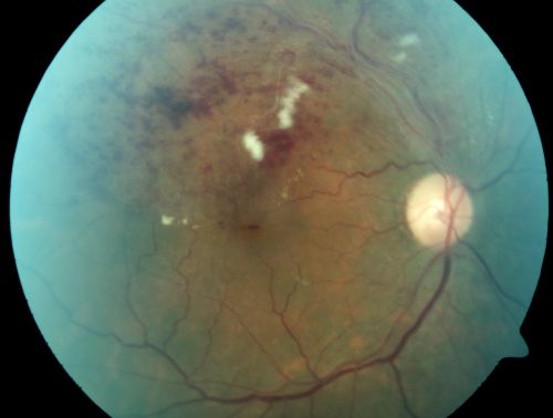 Branch Retinal Vein Occlusion with Cotton Wool Spot 
70-year-old man with blurred vision in the right eye for about one or two months. OD is 20/80, OS is 20/25.
